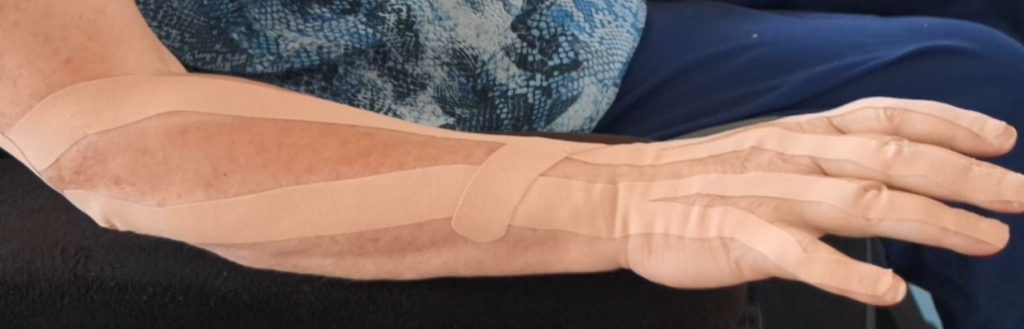 MS arm with tape