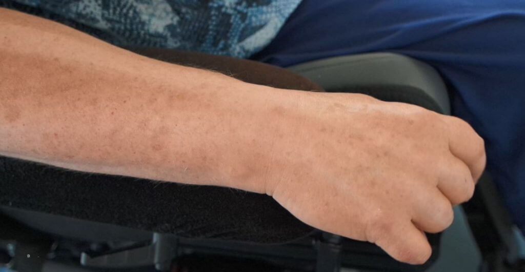 MS arm without tape