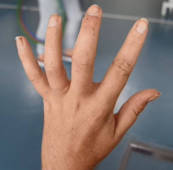 MS hand without tape